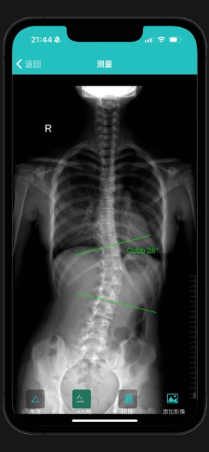 脊柱侧弯iPhone版截图3